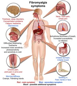 تشخيص الألم العضلي الليفي "الفيبروميالجيا" - fibromyalgia ألم واضطراب النوم وتيبس المفاصل 