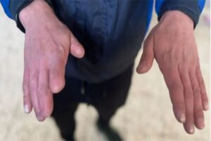 أصابع يد سجين مقطوعة تحت التعذيب في سجن صيدنايا سجن الرعب والانتهاكات
